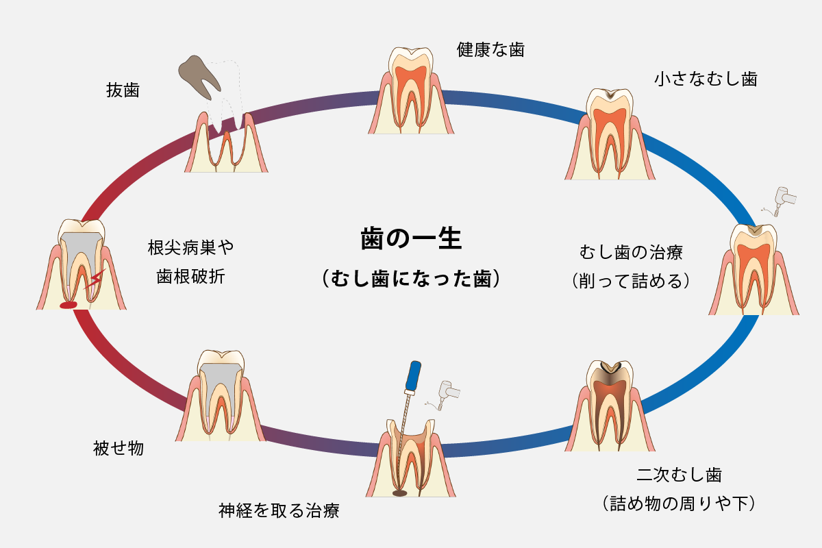 インプラント